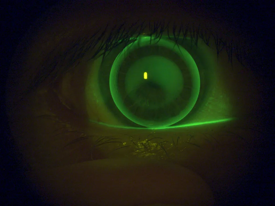 Fluoreszeinbild einer formstabilen Kontaktlinse auf einem Auge mit Keratokonus